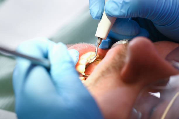 Best Emergency Root Canal Treatment in Everman, TX